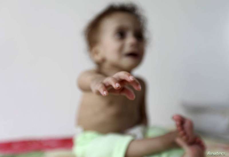 «يونيسف»: ملايين الأطفال في اليمن معرضون لسوء التغذية بسبب نقص التمويل